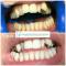 igiene dentale + sbiancamento click BLANCONE